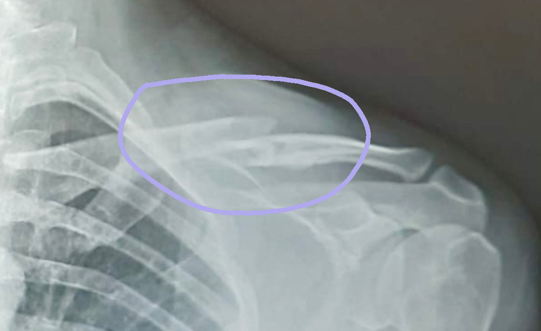 Collarbone 02